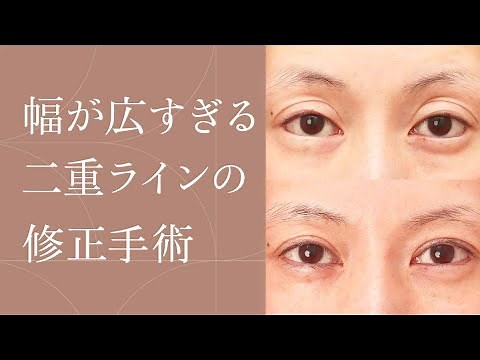 【他院修正】幅が広すぎる二重ラインの修正手術