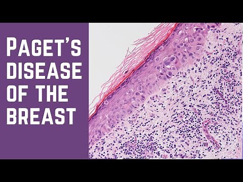 Paget's Disease of the Breast - Pathology mini tutorial