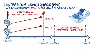 Video: Postpartum hemorrhage: Nursing - Video Explanation! | Osmosis | Osmosis