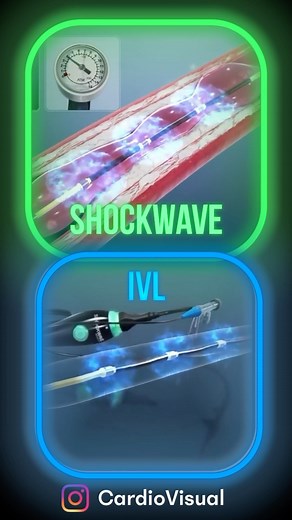 17K views · 15 reactions | Coronary Calcified Plaque & Shockwave IVL...