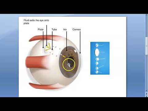 Ophthalmology Glaucoma Drainage Devices Seton Ex Press implant Molteno