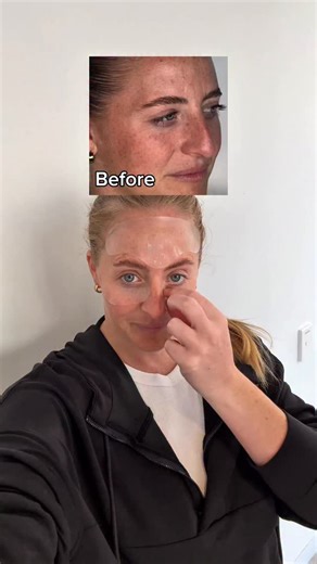Results like these after just one night! You’ll be obsessed with your skin-smoothing Wrinkle Patches too 😍 | Wrinkles Schminkles