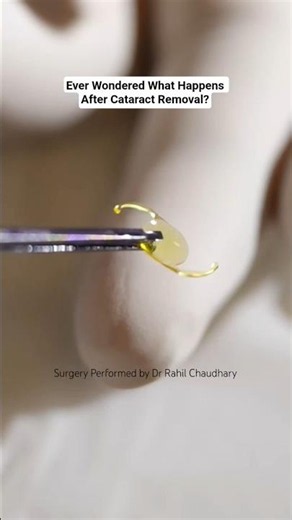 Ever Wonder What Happens After Cataract Removal?