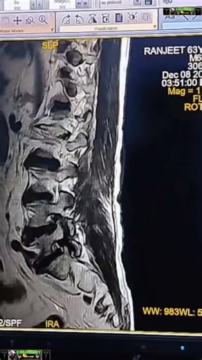 MRI LUMBER SPINE
