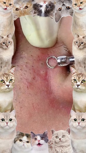 My god!!!😱💕#pimple #cyst #blackhead #USblackhead #cystpopping #fyp