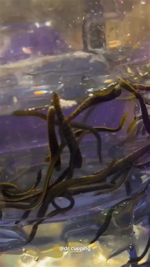 6.9K views · 12 reactions |  Leech Therapy (Hirudotherapy) Leech...