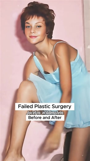 Celebrity Plastic Surgery Fails: Before and After