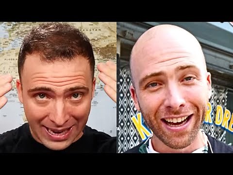 BIG YouTubers Who Went BALD