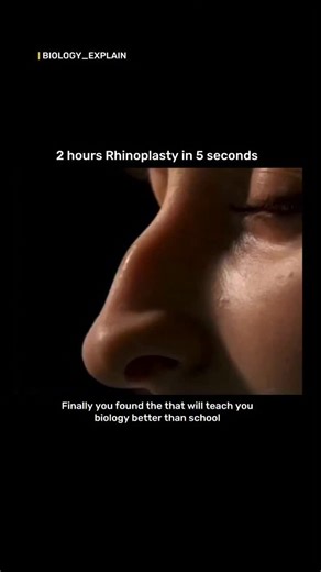 medical / biology explain on Instagram: "Rhinoplasty, or a “nose job,” is a plastic surgery procedure to change the shape, size, or proportions of the nose by altering its bone, cartilage, and skin to improve appearance or correct functional issues like breathing problems. The surgery involves making incisions inside or on the nose to access and reshape the underlying structures, followed by internal or external splints to hold the new shape during healing. Recovery includes resting with your he