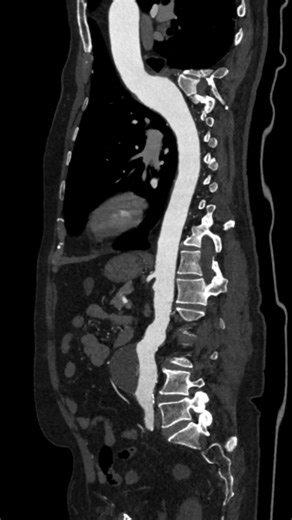 Abdominal Aorta Aneurysm #radiographer #radiology #radiologylife #MRI #radiologytechnologist #radiologist #xraytech #XRay #radiography #mriscan #angiography #abdominalangiogram #CTscan | CT Scan & MRI for Beginners
