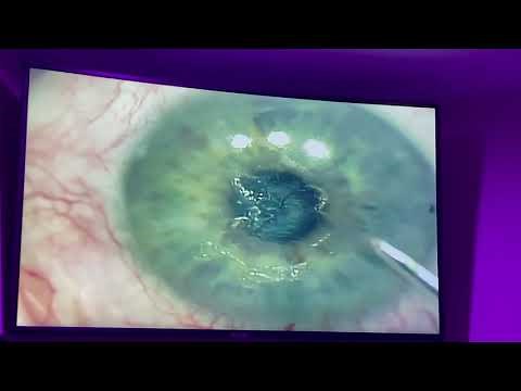 Watch Corneal Scars be Removed in Minutes!