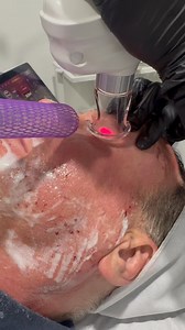 ✨ TRANSFORMATION IN PROGRESS: Even our clinic manager Adrian trusts nurse Dearbhla with his delicate eye area! 👀 Watch as Dearbhla precisely delivers our Cutera Secret PRO CO2 laser treatment to Adrian’s eyelids. This advanced fractional CO2 technology works by creating microscopic channels in the skin that trigger an immediate collagen remodeling process. The magic of CO2 laser for eyelids: • Precisely targets the thin, delicate skin around eyes • Stimulates deep collagen production for natura