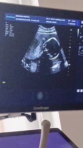 1.6K views · 17 reactions | " Good Afternoon Milly Beauty Products I Just Cam From The Hospital & I Want To Still Confirm That Your Drink Is A Powerful One After 6 years....And Trust Me All My 4 Sisters Are A Testimony To Your Drink Am Finally Pregnant The Final And Fifth Sister  ........Incase you're Doubting Ka Scan Ako apo ." #viralreels #viral #Amazing #highlight #followers #everyone #BreakingNews | Milly Beauty Products | Facebook