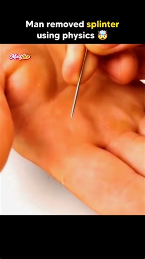 Mastfiles on Instagram: "A man had a wooden splinter stuck in his hand ✋. Instead of using tweezers, he used a syringe 💉 — a medical tool that can create suction. By pulling the plunger, he created negative pressure (vacuum) over the affected area. This suction force helped pull the splinter outward, without cutting the skin 🩹. ⚙️ This is a real-life example of physics in action — using air pressure and vacuum principles to solve a common problem. Physics in action — Simple • Smart • Scientifi