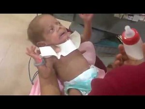 How to feed the baby in NICU