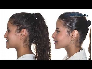 Jaw surgery Case# 111: Alba -Class III, Maxillary retrusion, TMJ problems