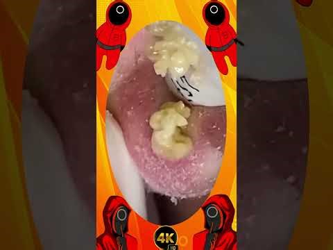 Blackheads Removal | Acne Treatment and Very Satisfying Satisfying Pimple pop #blackheads