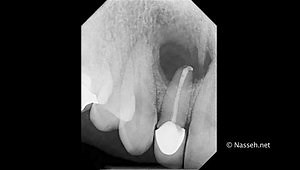 Retrograde/Orthograde Root Canal Therapy