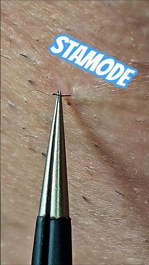 Real Close-Up Satisfying Neck Hair Tweezing 😌 #tweezing #beard #plucking #facialhair