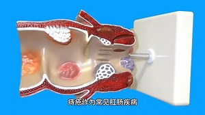 塞普胺：痔疮治疗新突破，带来高效解决方案