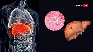 MAFLD — When Alcohol Is Not The Only Reason For Fatty Liver