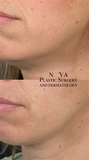 NOVA Plastic Surgery and Derm on Instagram: "Kybella Transformation✨ Before ➡️ After Just one session with two vials of Kybella and this patient is already seeing a noticeable improvement in submental fullness. Results will continue to refine over the next several weeks! #beforeandafter #novaplasticsurgery #kybella"