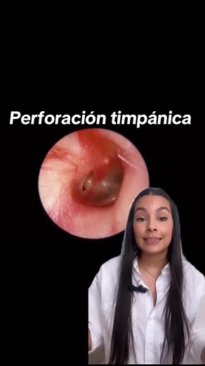 ¿Perforación Timpánica? Descubre los Síntomas