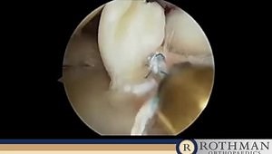 Oblique Radial Tear of the Lateral Meniscus Posterior Horn