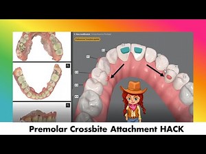 Invisalign ClinCheck - Attachment HACK to Correct a Premolar Crossbite