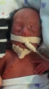 Baby born at 22 weeks opens his eyes for the first time. 😍The Conservative Govt. want to make it legal to abort babies the same age in NI. 😪 Video credit: Benson Artman - 22 Week Preemie Take action. Email your MP now: https://righttolife.org.uk/savelives | Right To Life UK