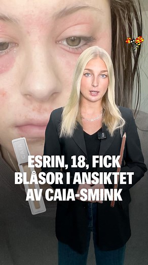 Esrin Pettersson, 18, har aldrig haft problem med sin hy. Men efter att ha använt smink från Caia fick hon vätskefyllda blåsor i hela ansiktet. Och hon är inte ensam. Reporter: Erica Eneström | Kvällsposten