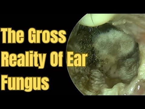 Extreme Ear Wax Removal - You Won't Believe What Came Out! (29)