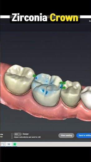 Zirconia Crown Procedure Explained : Pros and Cons in 1 minute