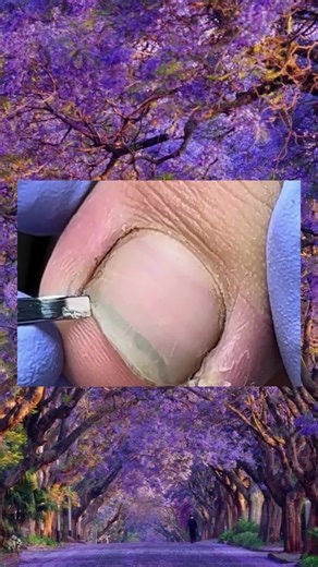 Effective Ingrown Toenail Removal Techniques