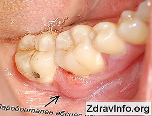 Гноен синузит - причини, симптоми и лечение на 👃👃 Портал На Синусите И Др. - 2025