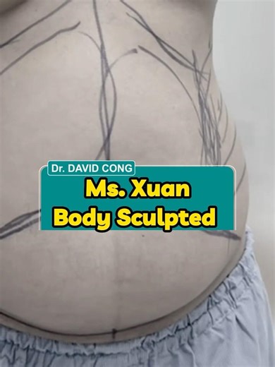 Vaser Lipo 360 Transforms Ms. Xuan | DR DAVID CÔNG