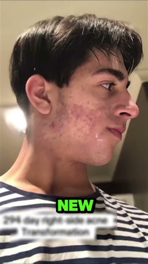 Satisfying Acne Healing Time lapse