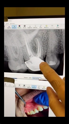 Missed db2! #dentists #dentalartistry #dentaltreatment #rootcanaltherapy
