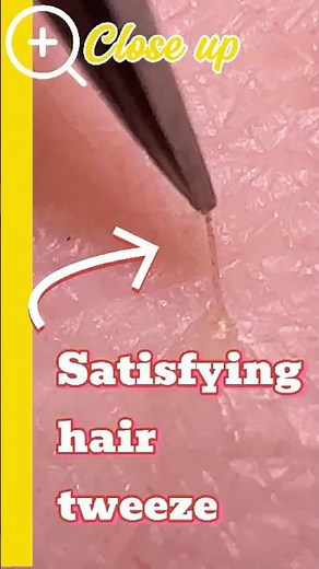 Close up ingrown hair removal
