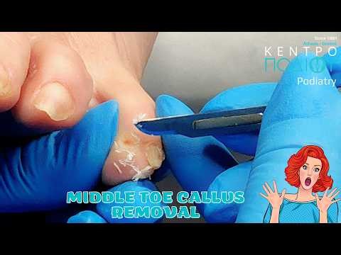 Middle toe callus removal #kentropodiou #κεντροποδιου #foot #podologos #podiatrist #podiatry #toe