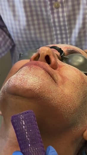 Peña Plastic Surgery on Instagram: "The SmartXide DOT™ Therapy fractional CO2 laser creates thousands of microscopic thermally treated zones, called DOTs in your skin. The DOTs target and repair wrinkles, pigmented lesions, live spots, sun damage, acne and scar tissue. Also helps with skin tightening and stimulating collagen. The technology can also be used on the neck, décolleté, arms, hands and legs. Recovery time with the use of plan base exosome pre and post care kit is 7 to 10 days."