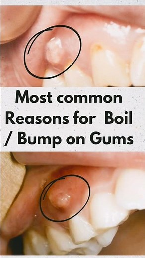 Tooth Abscess/ Boil in gingiva/ Gum