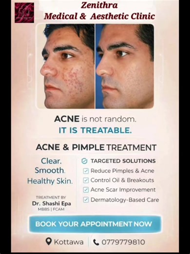 Effective Acne Treatment Tips by Dr. Shashi Epa