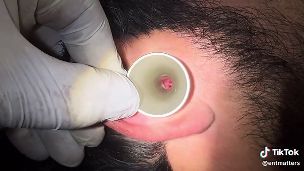 Successful Removal of a Foreign Body Ear…… A fragment of a Shell/Crust Lodged Deep in the Ear Canal, Providing Immediate Relief and Comfort. #entmatters #Foreign body ear #Crust in ear # Foreign Body Extraction #Ear#Earlth #Hearing restoration