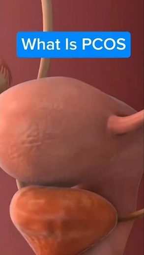 Unlocking the Mystery of Polycystic Ovarian Syndrome (PCOS)! #facts #health