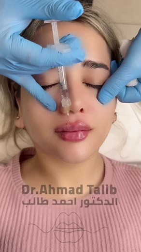 Lip Enhancement Procedure with Dr. Ahmad Talib