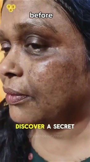 Clean Dark Spots & Pigmentation Naturally At Home | Pigmentation Removal Pack #pigmentation #shorts