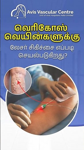 How Does Laser Treatment for Varicose Veins Work? | Dr. Keerthen Mahendran | Avis Vascular Centre