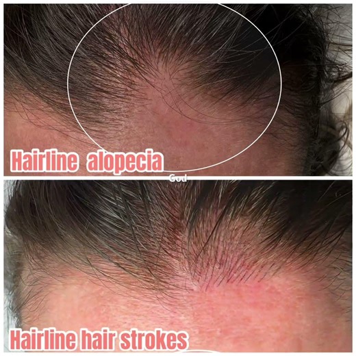 Hair strokes added to hairline alopecia