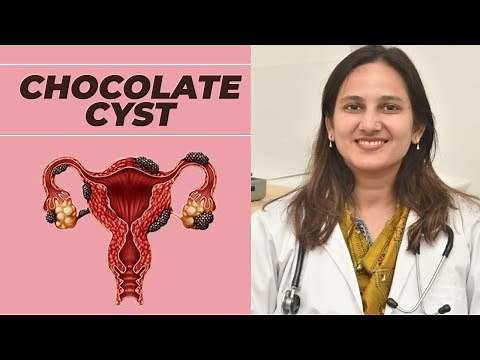 What Is Chocolate Cyst? | Chocolate Cyst (Ovarian Endometrioma) | Cause | Symptoms | Treatment